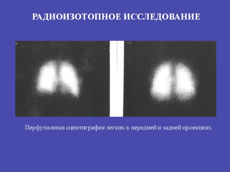 РАДИОИЗОТОПНОЕ ИССЛЕДОВАНИЕ Перфузионная сцинтиграфия легких в передней и задней проекциях.